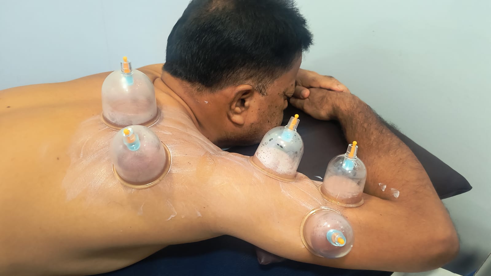 Cupping therapy